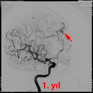 gamma knife avm