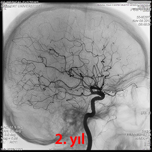 gamma knife avm