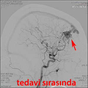 gamma knife avm