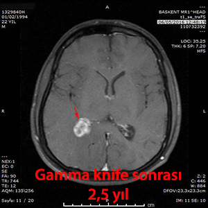 gamma knife sonrası menenjiom