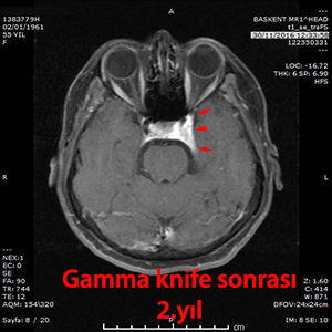 menenjiom gamma knife sonrası