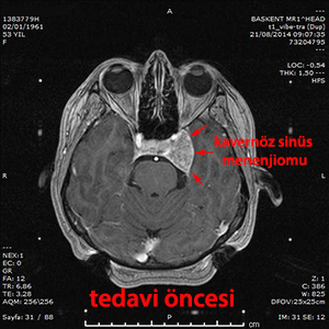 menenjiom tedavi öncesi