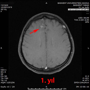 gamma knife avm