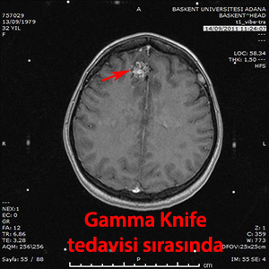 gamma knife avm