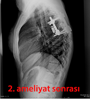 osteosarkom postop 1