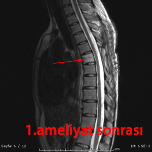 osteosarkom postop mr