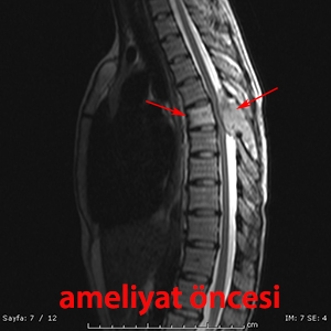 osteosarkom preop MR