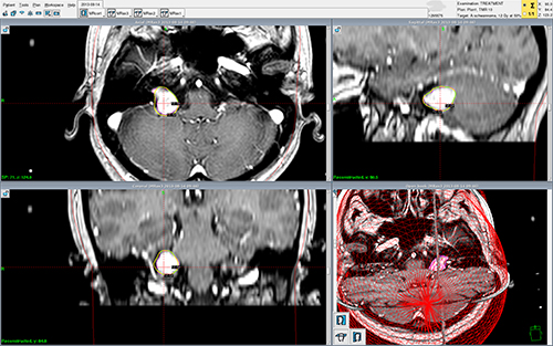 gamma knife plan