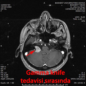 gamma knife schwannom