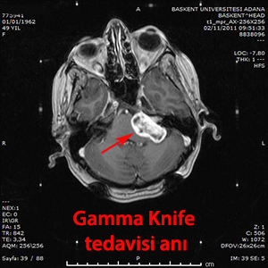 gamma knife akustik