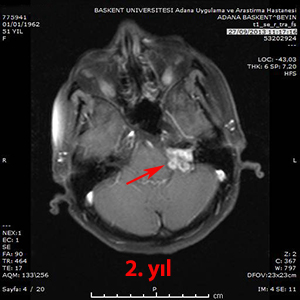 gamma knife schwannom