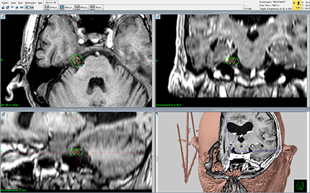 trigeminal nevralji gamma knife