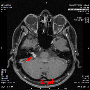 gamma knife akustik