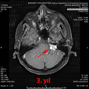 gamma knife schwannom