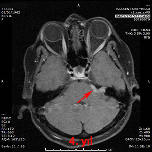 gamma knife aksutik schwannom