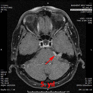 gamma knife akustik schwannom