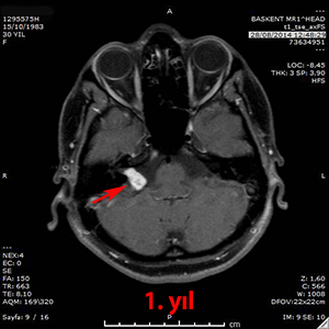 gamma knife schwannom