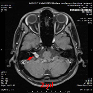 gamma knife schwannom